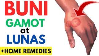 Gamot at Lunas sa BUNI  Sanhi Sintomas ng BUNI sa BALAT  Home Remedies Ointment Para Mawala [upl. by Novelia122]