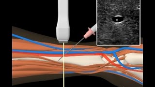 Anlage invasive arterielle Druckmessung [upl. by Grantland]