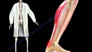 Achilles Tendon Stress amp Strain  Everything You Need To Know  Dr Nabil Ebraheim [upl. by Ameehsat442]