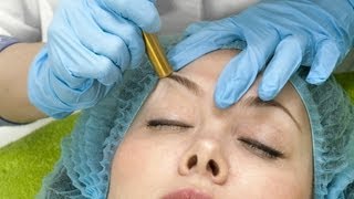 Microdermabrasion amp Acne Scars  Acne Treatment [upl. by Avehstab]