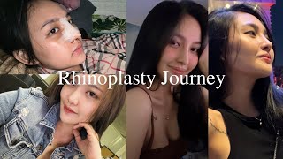 My Rhinoplasty Journey pt1 Best surgeon recovery healing stage [upl. by Surbeck579]