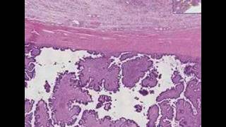 Histopathology OvaryBorderline ovarian tumor [upl. by Allehcim]