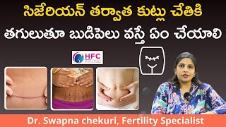 సిజేరియన్‌ కుట్లు బుడిపెల్లా తగిలితే ఏం చేయాలి  Feeling Lump Around CSection Incision  HFC [upl. by Eimmaj]