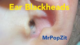 Ear Blackhead extractionsDeep in the ear blackheadsQuick extractions one dry one juicy MrPopZit [upl. by Laehcor897]