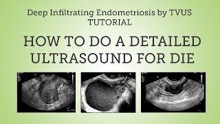 How to Do a Detailed Ultrasound for DIE Tutorial [upl. by Limak]