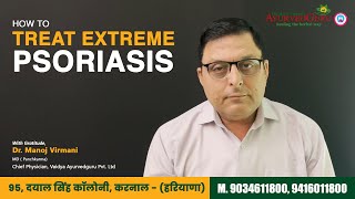 How to treat extreme Psoriasis  Dr Manoj Virmani  Ayurvedguru  psoriasistreatment psoriasis [upl. by Neddy]