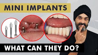 Mini Dental Implants What Can They Do [upl. by Anaira]