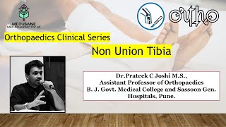 NON UNION  TIBIA  CASE PRESENTATION  DRPRATEEK C JOSHI MD  MEDUSANE [upl. by Elakram993]