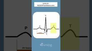 EKG Waveforms  what do they look like [upl. by Joachima439]