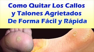 Como Quitar Los Callos Delos Pies y Talones Agrietados COMO CURAR CALLOS EN LOS PIES [upl. by Leis]