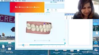 Invisalign Class II deep bite correction [upl. by Mallin870]