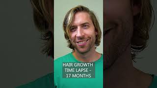 Hair Growth Time Lapse  1 Year amp 5 Months [upl. by Neetsuj]