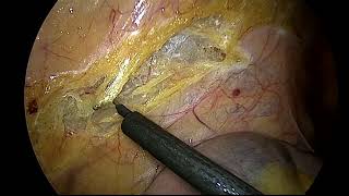 laparoscopic left hemicolectomy for carcinoma descending colon by Dr Rashesh Solanki [upl. by Ettezel]