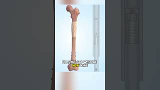 Limb Lengthening science medfacts medifact medicaleducation facts medicalscience [upl. by Slin]