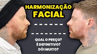 HARMONIZAÇÃO FACIAL MASCULINA Antes e Depois  Respondendo Dúvidas sobre o Procedimento [upl. by Imeon]