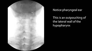 Swallowing Pharyngeal ear [upl. by Stratton]