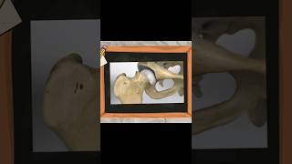 What is SCFE  limp limping ortholectures orthopaedics orthodoc ortho scfe sufe [upl. by Nibot930]