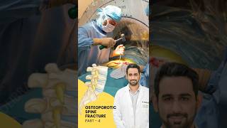 Treatment of Osteoporotic spine fracture  Dr Dheeraj Batheja  Part 2 doctor spinehealth [upl. by Mcferren]