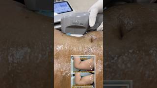 HIFU treatment 😍skincare hifu weightloss chennai thebrownaestheticskindoctor fatloss kilpauk [upl. by Erdied549]