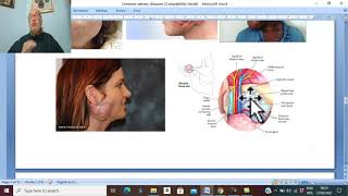 Head and neck surgery in Arabic 8  Acute bacterial sialadenitis  by Dr Wahdan [upl. by Marvella]