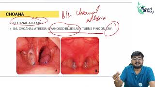 Choanal Atresia  By Dr Shubham Mittal  ENT [upl. by Ambrogio998]