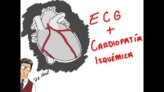 INFARTOS Y ECG COMO NADIE TE LO HA EXPLICADO [upl. by Notsob696]