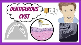 ORAL PATHOLOGY  DENTIGEROUS CYST [upl. by Longawa]