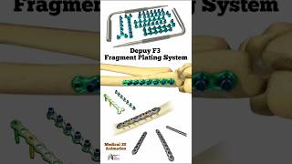 Depuy F3 Fragment Plating System medical animation 3d short Biology with Aliya [upl. by Barbara]