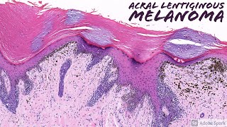 Acral Lentiginous Melanoma Dermatopathology [upl. by Nils]