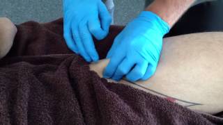 Dry Needling Rectus Femoris [upl. by Anafetse]