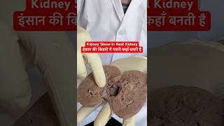 इंसान की किडनी में पथरी कैसे और कहाँ बनती है । Kidney Stone in Real Kidney viral shorts trending [upl. by Landa]