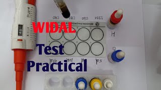 Widal Test Practical  Widal test for typhoid  Typhoid test in hindi  Typhoid ke liye test  विडाल [upl. by Eikcuhc]