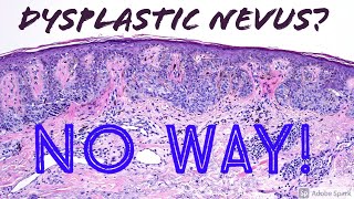 Melanoma Lentigo Maligna Type vs Dysplastic Nevus 5Minute Pathology Pearls [upl. by Studnia]