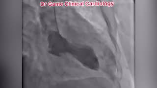 Takotsubo cardiomyopathy  Broken heart syndrome  Cath AngiogramThe Echo Channel [upl. by Freeborn]