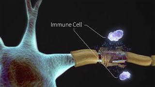 What is Multiple Sclerosis [upl. by Ayaet]