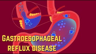 Gastroesophageal Reflux Disease GERD  CRASH Medical Review Series [upl. by Hartmann]