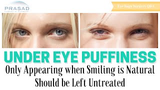 Puffiness Under Eyes that Only Appears When Smiling Does Not Need Cosmetic Treatment [upl. by Nicko670]