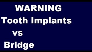 Tooth Implants vs Bridge  Pros Cons Costs and Warning [upl. by Karlyn]