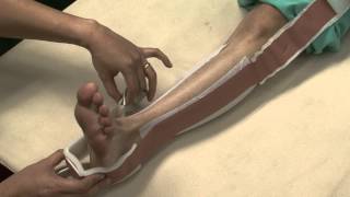 Skin traction video lecture CMU [upl. by Eilsil137]