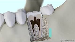 Protocole de dévitalisation dune dent ou traitement endodontique [upl. by Eibrad]