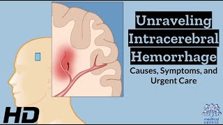 Intracerebral Hemorrhage Unveiled Understanding the Whys Whats and Hows [upl. by Anilesor656]