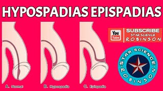 HYPOSPADIAS EPISPADIAS IN STAR SCIENCE ROBINSON [upl. by Angel]