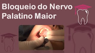 Bloqueio do Nervo Palatino Maior [upl. by Lemay]