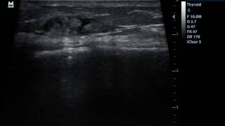 US guided block of the Infrapatellar branch of the Saphenous nerve [upl. by Venetis]