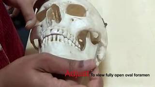 Gasserian ganglion Trigeminal block  made simplified by demo on the skull [upl. by Jeffcott]