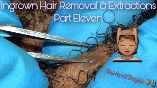 ASMR Ingrown Hair Removal amp Extractions 11 🔍 Beard amp Neck Area [upl. by Harrus638]