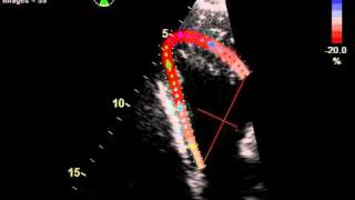 RIGHT VENTRICLE MYOCARDIAL INFARCTION STRAIN [upl. by Melmon269]