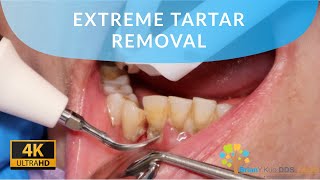 EXTREME TARTAR REMOVAL satisfying dental dentist [upl. by Letnuahc158]