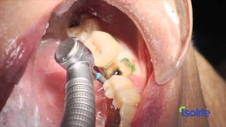 Isolite  The best isolation system for dental procedures [upl. by Sadye566]