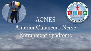 ACNES abdominal cutaneous nerve entrapment syndrome [upl. by Herzen]